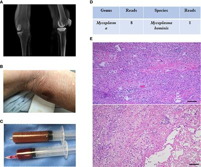 Optimization and standardization of mNGS-based procedures for the diagnosis of Mycoplasma periprosthetic joint infection: A novel diagnostic strategy for rare bacterial periprosthetic joint infection